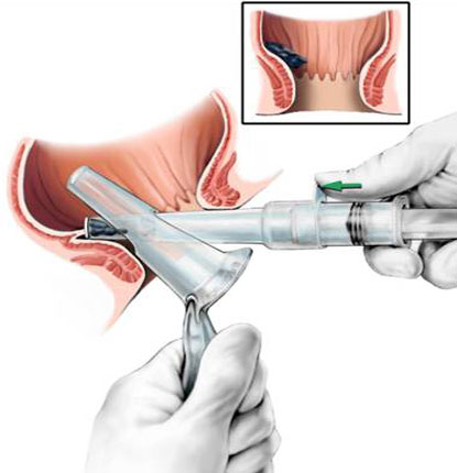 Colorectal Surgery And Hemorrhoid Management