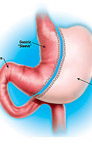 Bariatric Surgery