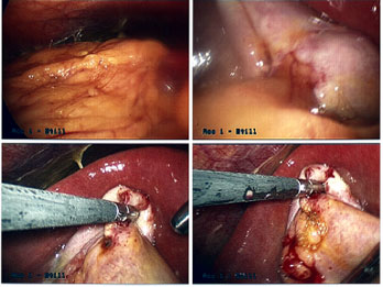 Perforated Gall Bladder